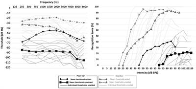 Amplification of the poorer ear by StereoBiCROS in case of asymmetric sensorineural hearing loss: effect on tinnitus